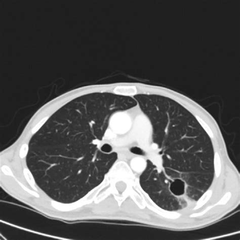 Axial Cut Of Ct Chest Without Contrast Showing Left Lower Lobe Nodule