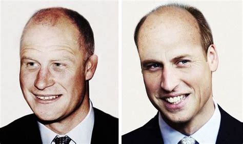 Prince William And Prince Harry Are Both Going Bald How