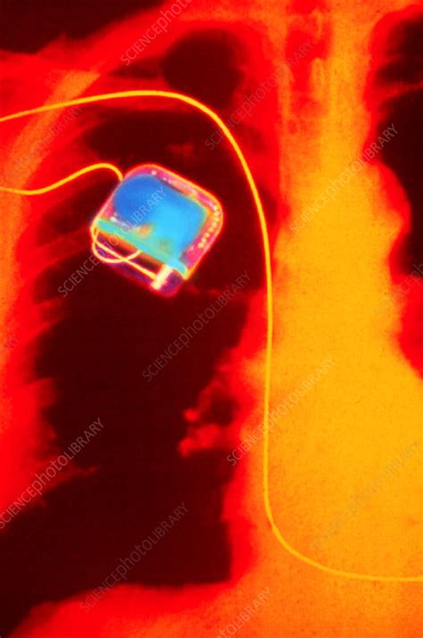 Coloured X Ray Of Implanted Heart Pacemaker Stock Image M5000015