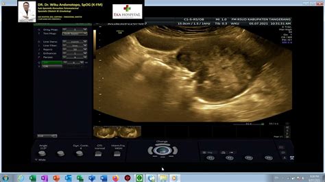 Cervical Uterine Sarcoma Dr Wiku Andonotopo Youtube