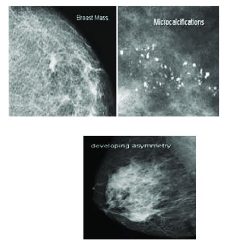 Common Abnormalities In Mammogram Images Download Scientific Diagram