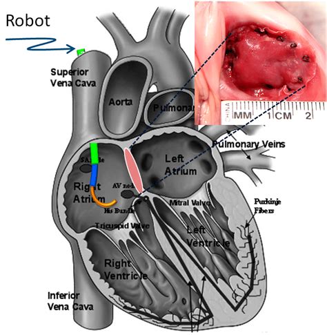 Robotic Patch Closure Of An Atrial Septal Defect Image Top Right Shows