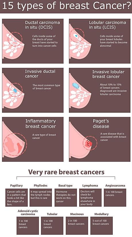 But one thing is for sure: Did you know there are 15 types of breast cancer? Here's ...