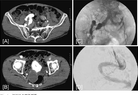 Figure 1 From A Case Of Isolated Internal Iliac Arterial Aneurysm With