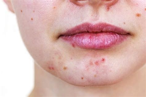 Hormonal Stress Pregnancy Chin Acne Cystic Causes Treatments