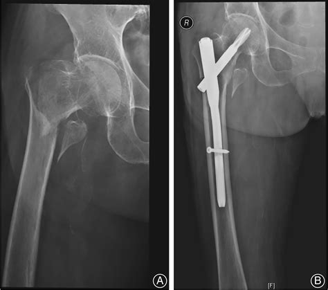 Risk Factors For Functional Outcomes Of The Elderly With Intertrochanteric Fracture A