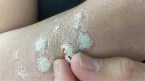 Barnacles Psoriasis Youtube