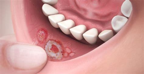 علاج قرح الفم المتكررة وأسباب تقرحات الفم واللثة ومحفزات ظهور تقرحات
