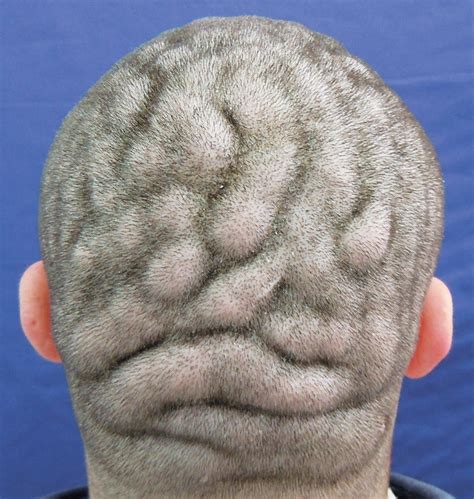 Condition Makes Mans Scalp Look Like Surface Of Brain Nbc News