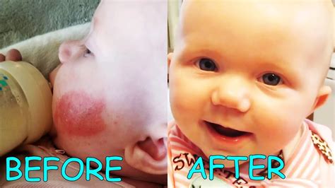 Baby Eczema Treatment 👶 Youtube
