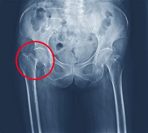 How Much Compensation For A Broken Hip Uk