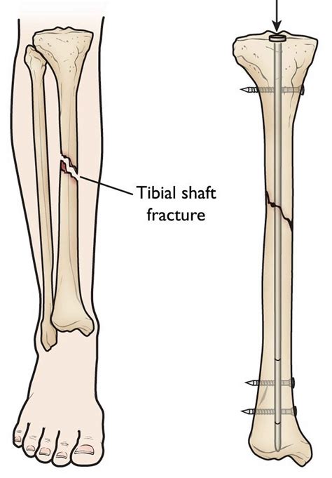 Oblique Bone Fracture