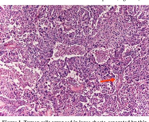 Pdf Oxyphilic Clear Cell Carcinoma Of The Ovary With A Minor Clear