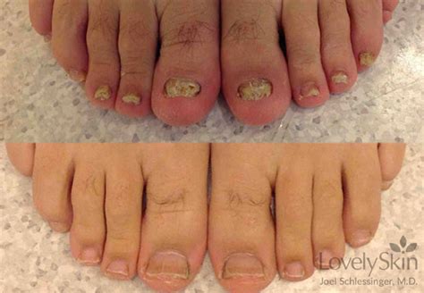 Toenail Fungus Before After Photos Skin Specialists