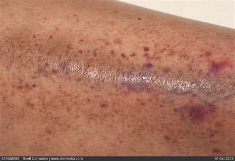 Stock Image Petechiae And Purpura Skin Lesions On The Lower Leg Of A