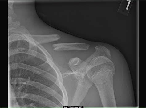Clavicle Bone Fracture