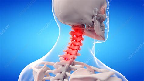 Painful Cervical Spine Illustration Stock Image F0349773