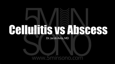 Differentiating Cellulitis From Abscess With Pocus Youtube