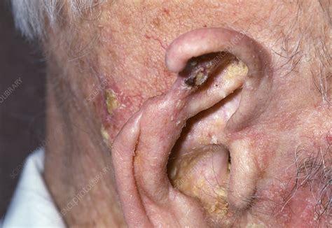 Ear After Cancer Treatment Stock Image M1310502 Science Photo