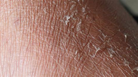 Dry Skin Patches On Elbows