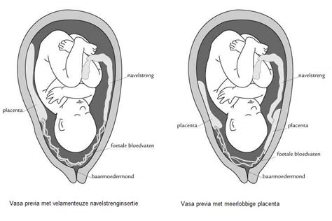 In many women diagnosed with placenta previa early in their pregnancies, the placenta previa resolves. Placenta previa