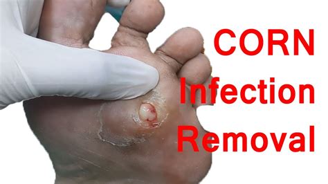 Corn Foot Pus Beneath Before After Video Youtube