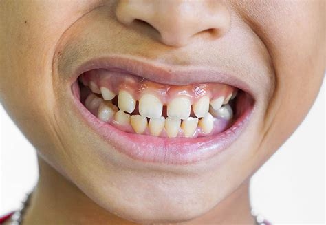The gap in the front teeth is called diastema in dental terminology. Everything About High Intense Tooth Diseases ...