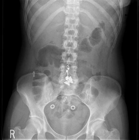 Approach To The Abdominal X Ray AXR Undergraduate Diagnostic Imaging Fundamentals