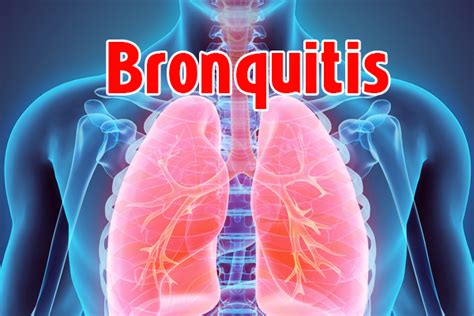 ¿qué Es La Bronquitis Aguda Clinica Hispana Airline