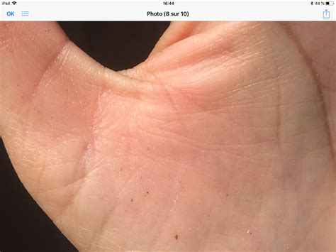 Red Brown Speckles On Palm Of Hands And Fingers Page 2 Science For Me