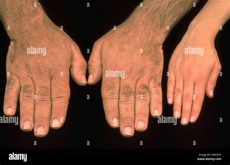 acromegaly hands