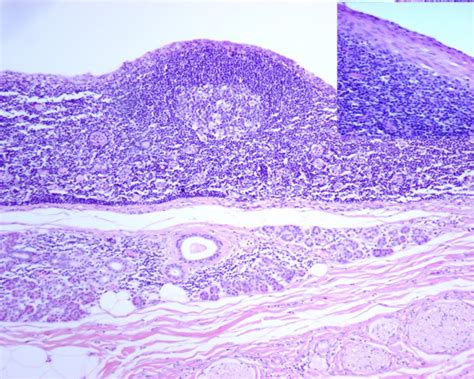 Branchial Cysts Within The Parotid Salivary Gland Head And Neck