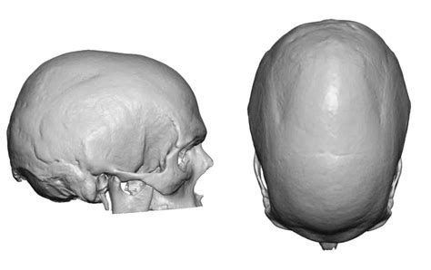 Plastic Surgery Case Study Sagittal Skull Reshaping With Sagittal