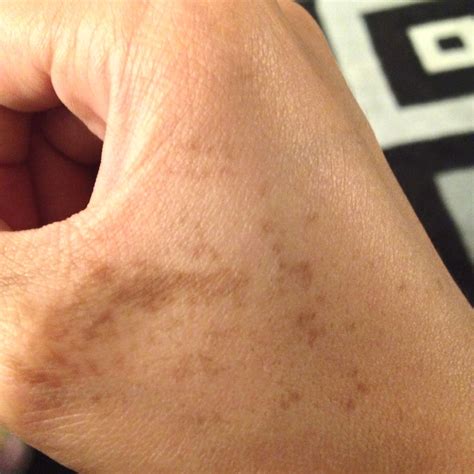 How To Get Rid Of Skin Discolorationbrown Spots Musely