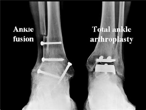 Emerging Technology In The Foot And Ankle Total Ankle Arthroplasty My Xxx Hot Girl