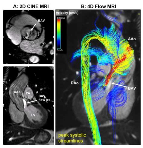 The D Cine A And D Flow Cardiovascular Magnetic Resonance Cmr B Download Scientific