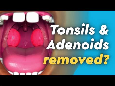 Tonsillectomy And Adenoidectomy Before And After