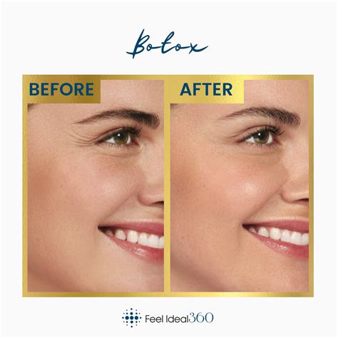Before And After Botox Feel Ideal 360 Med Spa Southlake Tx