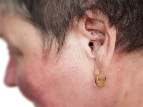 can you cure aural dermatitis ear eczema balmonds