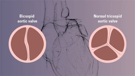 Bicuspid Aortic Valve Disease Causes Risks Treatment And Prognosis