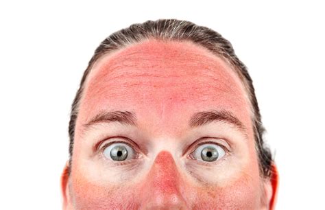Soothe Sunburn With These Home Remedies Mega Bored