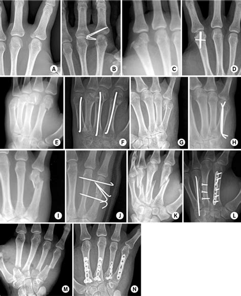 Example Of Metacarpal Fracture Treatments A B A Proximal Phalanx