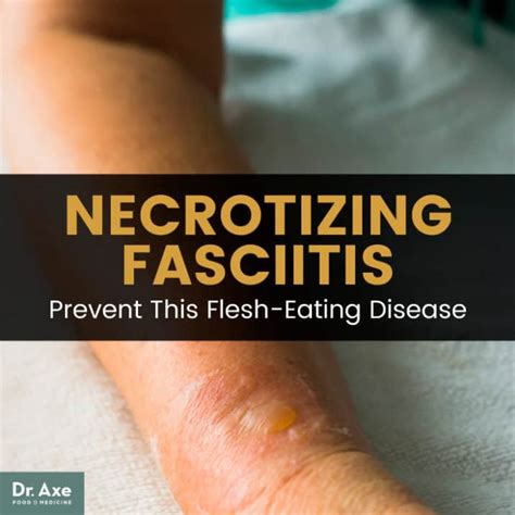 Necrotizing Fasciitis Avoid This Flesh Eating Disease Dr Axe