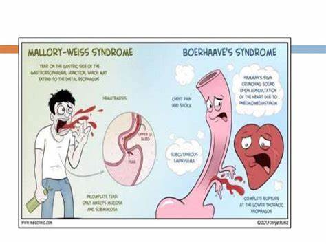 Гипоталамического синдром диета Синдром мэллори вейса (маллори вейсса): что это такое, лечение Синдром мэллори вейса (маллори вейсса): что это такое, лечение Гипоталамического синдром диета