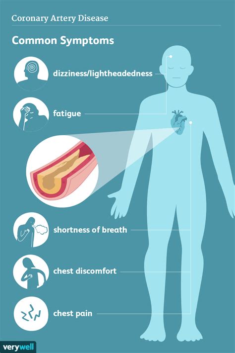 Coronary Artery Disease Signs Symptoms And Complications