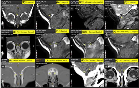 Al Pre‐operative And Post‐operative Images Ad Pre‐operatively