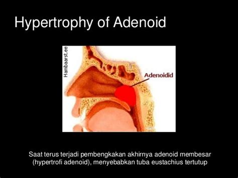 Hypertrophy Of Adenoid