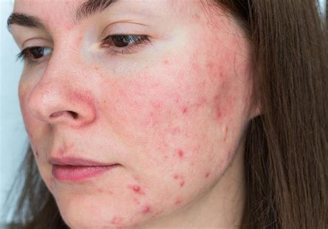 4 Effective Ways To Reduce Acne Scars Manas Med Spa Laser And