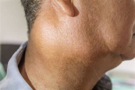 These Are The Most Common Signs Of Lymphoma Like Swollen Lymph Nod