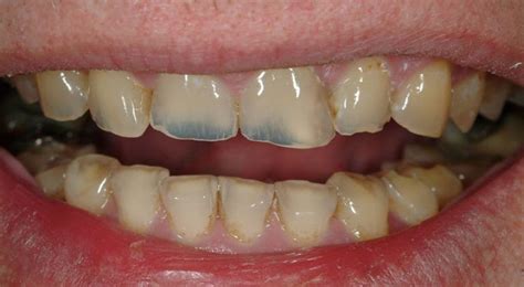 Erosión Dental Clínica Trei